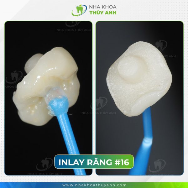 Miếng trám được chế tác từ vật liệu sứ hoặc composite tại phòng lab nha khoa.